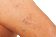 Image of spider veins. 