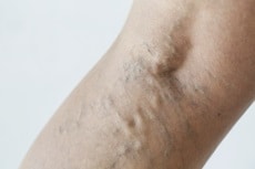 Image of varicose veins.