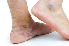 Image of venous insufficiency. 