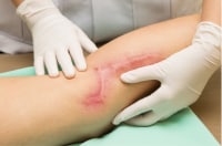 A plastic surgeon examines a burn wound on someone's leg.