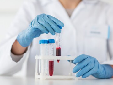 A physician examines blood samples for iron deficiency.